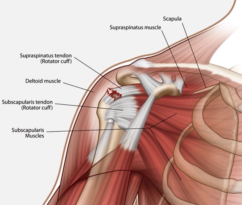 ROTATOR CUFF TENDON INJURY, DIAGNOSIS, TREATMENT AND RECOVERY