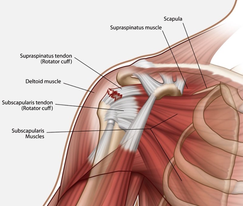 bilateral rotator cuff tendonitis